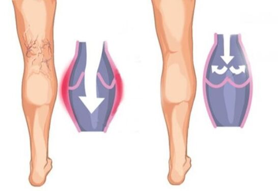 как выглядит варикозное расширение вен